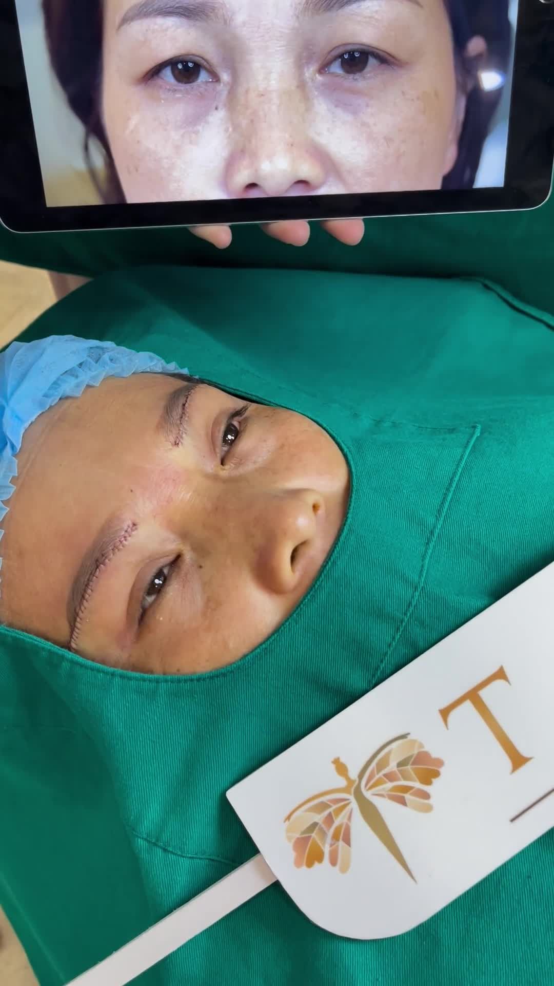 Sau 45 phút, đôi mắt tươi trẻ hơn với dịch vụ nâng cung mày tại TMV Tấm.